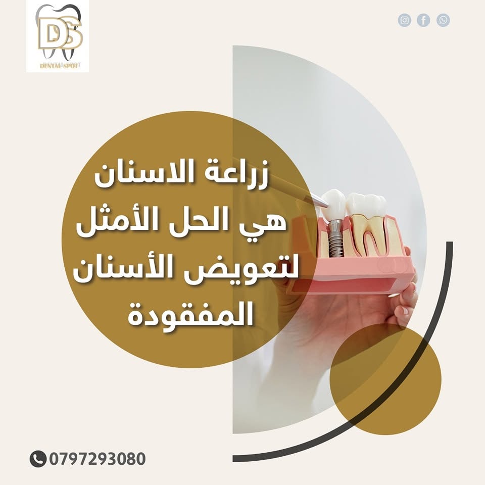 نموذج توضيحي لتلبيسات الأسنان في عيادة Dental Spot