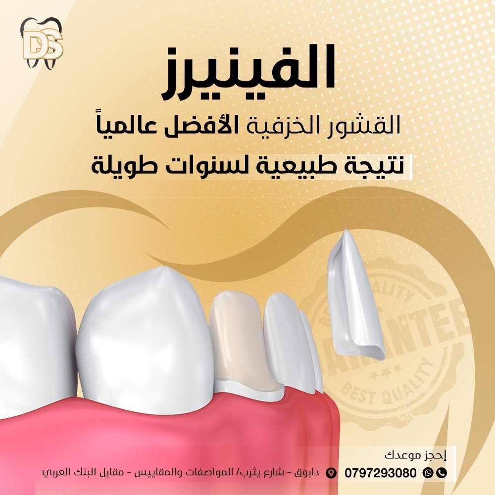 فينيرز الأسنان الخزفية في عيادة Dental Spot بعمّان