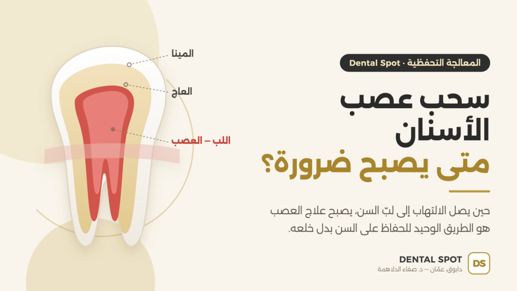 رسم توضيحي لمقطع داخل السن يبيّن متى يكون سحب عصب الأسنان ضرورياً — عيادة Dental Spot دابوق عمّان