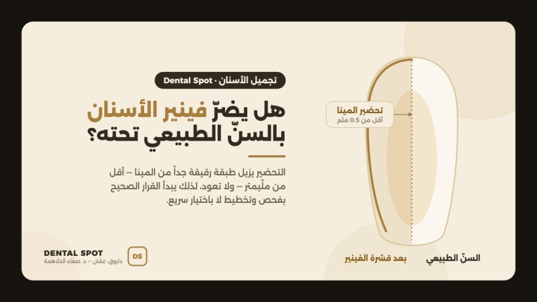 رسم توضيحي يقارن السن الطبيعي بالسن بعد تركيب فينير الأسنان ويبيّن طبقة المينا الرقيقة التي تُحضَّر — عيادة Dental Spot دابوق، عمّان