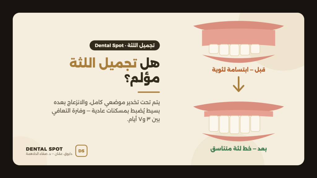 رسم توضيحي لابتسامة لثوية قبل تجميل اللثة وخط لثة متناسق بعده — عيادة Dental Spot دابوق، عمّان