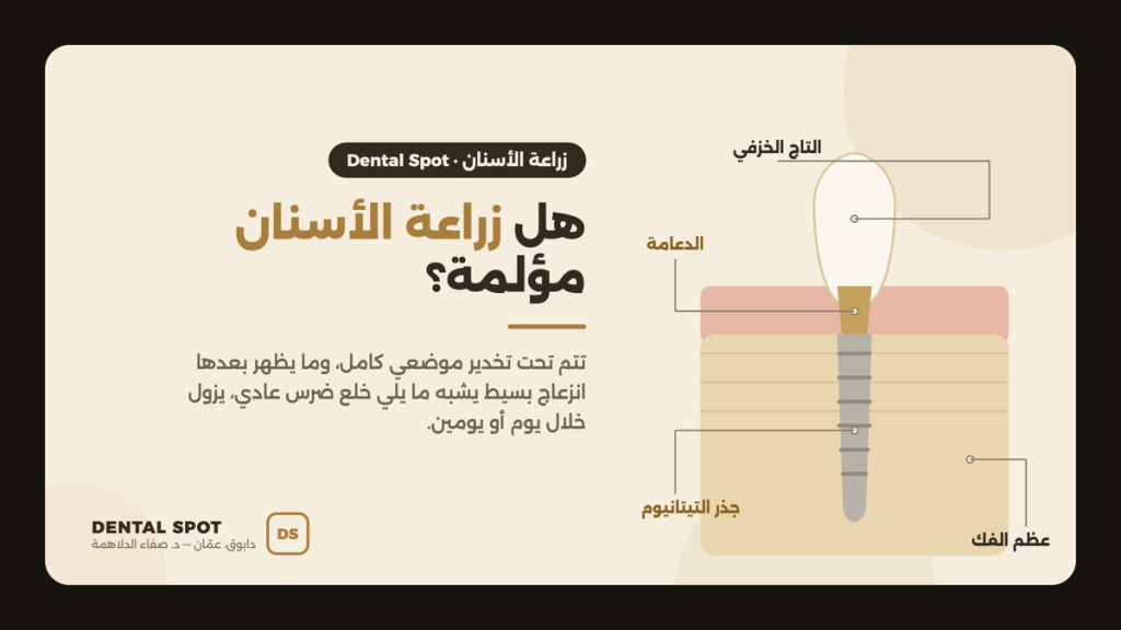 رسم توضيحي لمكوّنات زراعة الأسنان: التاج الخزفي والدعامة وجذر التيتانيوم داخل عظم الفك — عيادة Dental Spot دابوق، عمّان